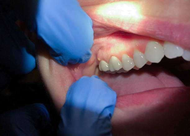Best Emergency Tooth Extraction in Sneads, FL